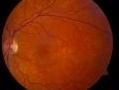 chimica: La retina artificiale biocompatibile e italiana -   Un team di ricerca dell'Iit ha sostituito i fotorecettori danneggiati della retina con un materiale sensibile alla luce, grazie a uno strato...